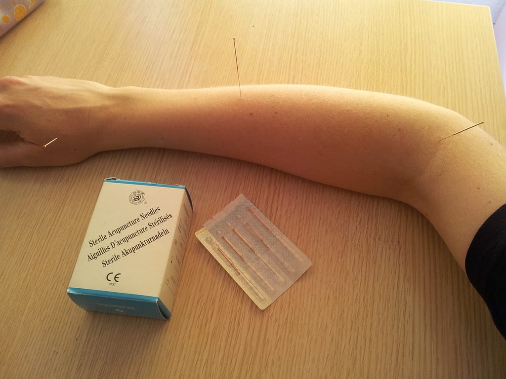 Acupuncture needles on an arm